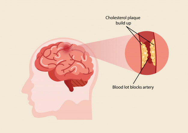 Brain Stroke