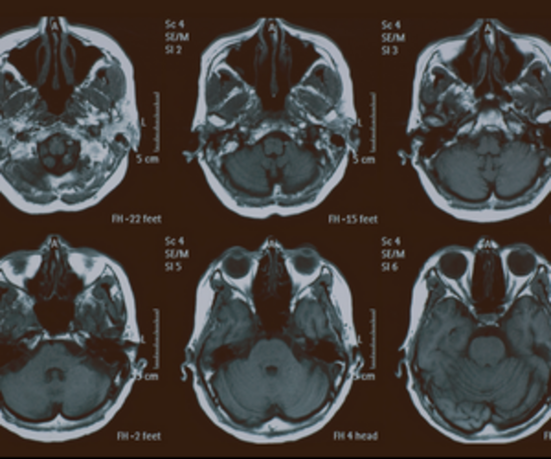 Neuropathy Screening